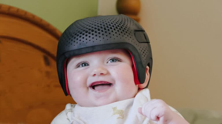 Baby wearing STARband cranial remolding helmet